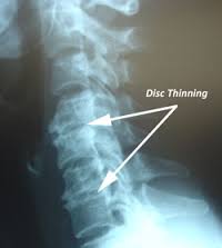 degenerative disc in thoracic spine