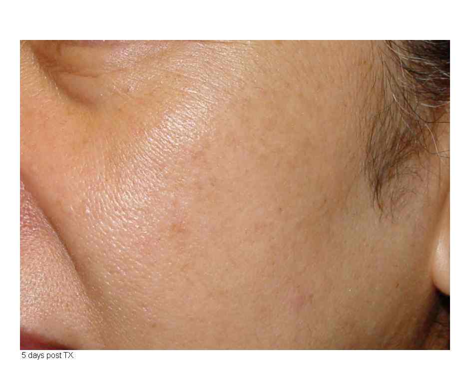 After photo of IPL limelight facial treatment in Calgary.