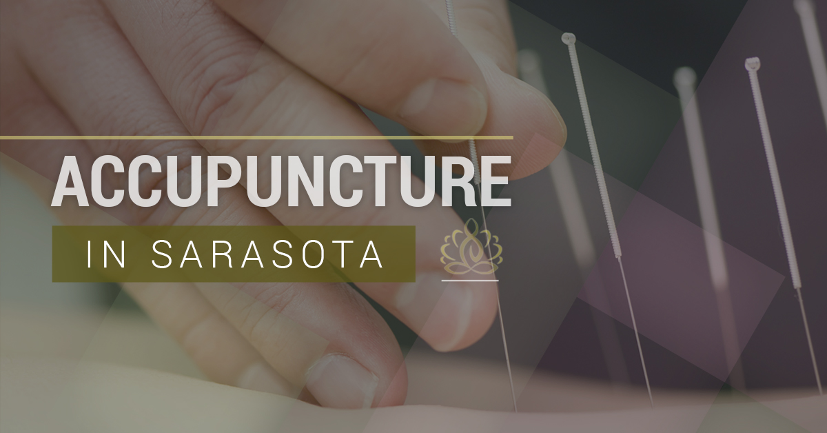 Acupuncture in Sarasota All Natural Healing