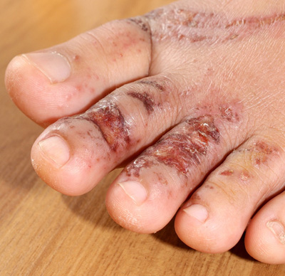 First Aid for feet from A Step Ahead Foot and Ankle Center