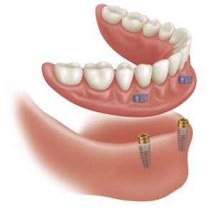 supported_dentures1