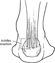 Achilles Insertion