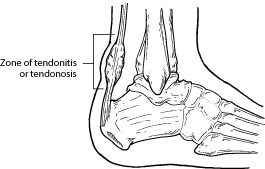 Zone of Tendonitis or Tendonosis