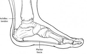 Plantar Fasciitis