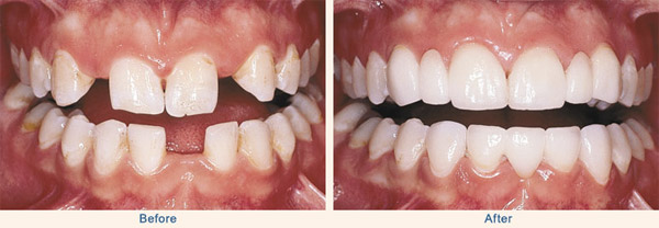 dental-bridge