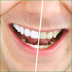 dental-teeth-whitening-santa-monica
