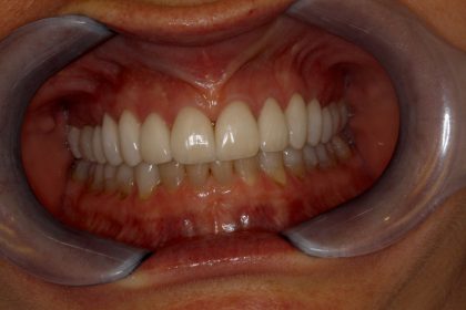 Full Mouth Reconstruction - After