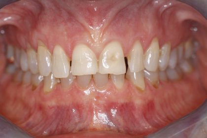 Full Mouth Reconstruction - Before