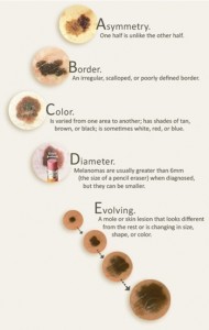 The American Academy of Dermatology's guide to suspicious moles