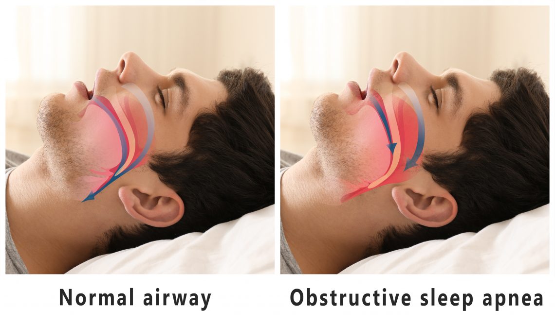 sleep apnea obstructs airways