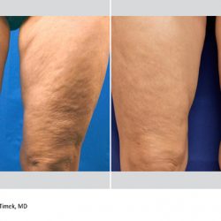 PiXel 8-RF Micro-Needling: Suffolk Skin Treatment