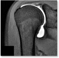 shoulder arthogram - orthopedics MR_shoulder_arthrogram
