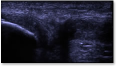 knee_ultrasound