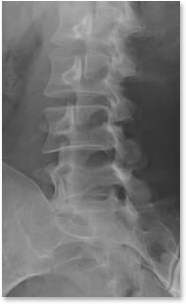 lumbar_facet