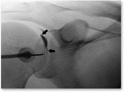 shoulder_injection_fluoro