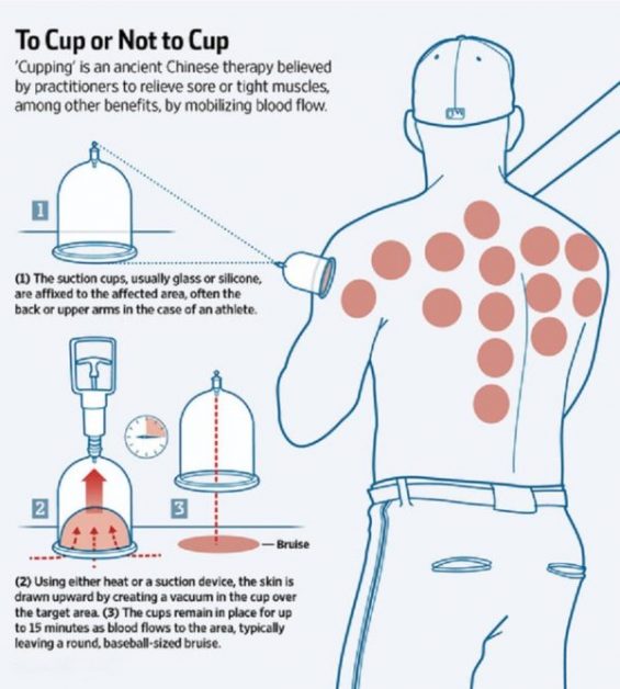 Olympic Fad 1 Cupping Core Physical Therapy