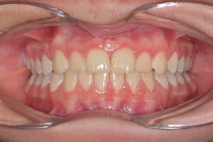 Figure 2. Same patient after final treatment. Actual patient of Dr. Edgren