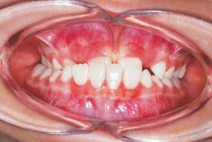Figure 1. Patient at 8 years of age before early interceptive treatment with a severe underbite and crossbite. Actual Patient of Dr. Edgren
