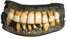 Washington’s dentures, that he wore to hide his edentulousness, were made from multiple materials. The last remaining complete set of Washington’s dentures are in the collection at Mount Vernon.