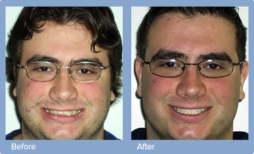 invisalign before and after newton invisalign ma orthodontics