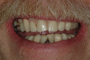 Dentures Kenmore Washington