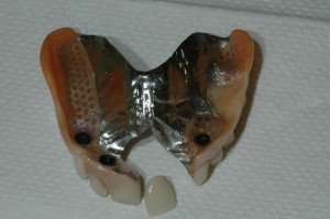 Partial Denture Kenmore