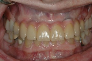 Dental Implants Kenmore