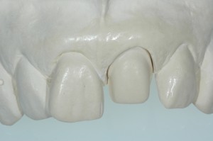 Porcelain Veneers Kenmore WA