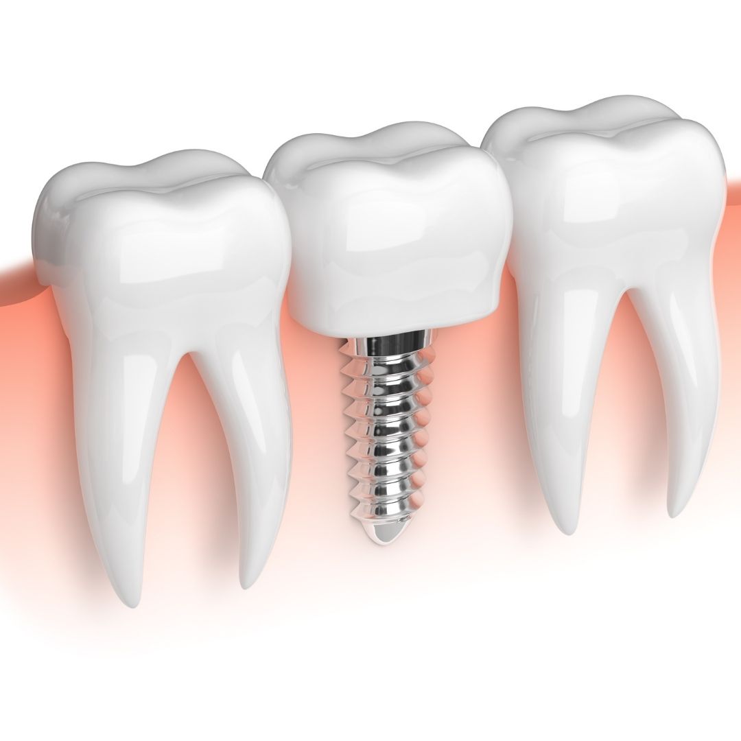 illustration of a dental implant