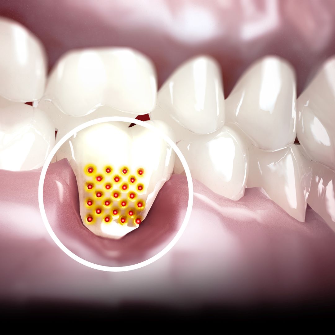 close up of gum and tooth