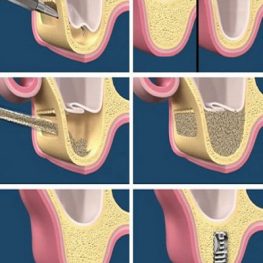 Periodontal treatment-periodtontics-sinus lift