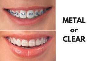 braces-metal or clear