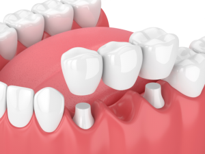 cosmetic dentist-dental bridges