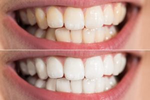 cosmetic dentist-teeth whitening