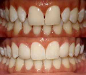 cosmetic dentist-veneers
