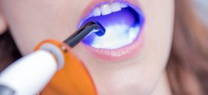 dental bonding 1