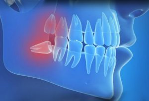 oral surgery-oral surgeon arlington va 2