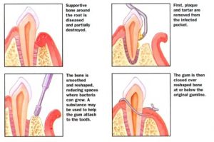 periodontal treatment-osseous surgery