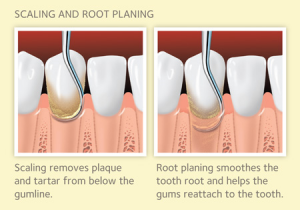 periodontal treatment-periodtontics-deep cleaning