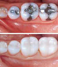 white cavity fillings
