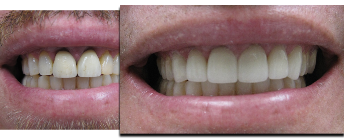 Porcelain Crowns and Veneers
