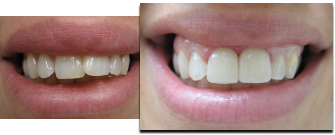 Porcelain crowns