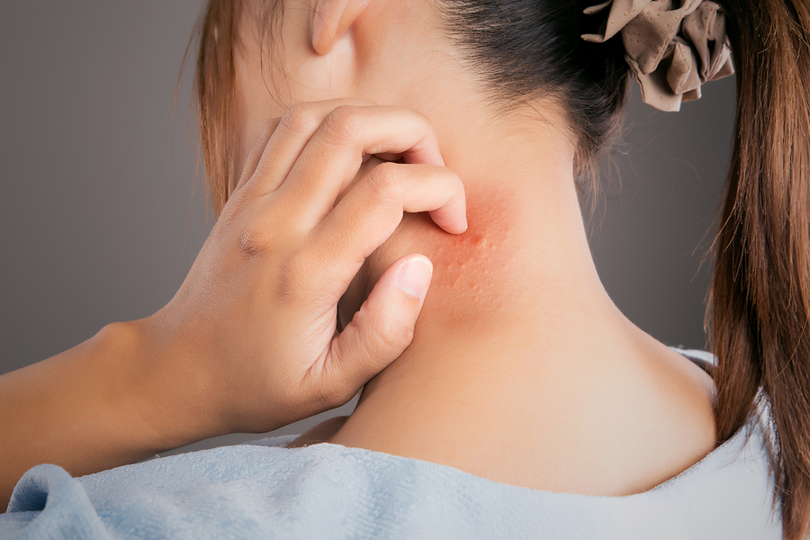 woman scratches neck because of lice