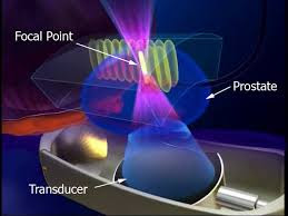 Sound energy converges to create a focal point where tissue is destroyed during HIFU.