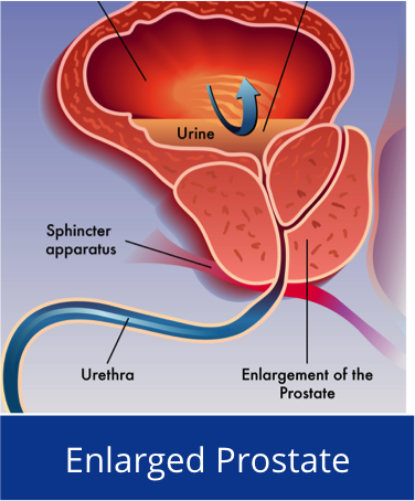 enlarged prostate gland