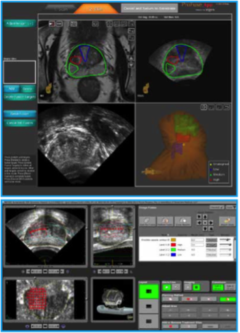 MRI Fusion with Sonablate HIFU