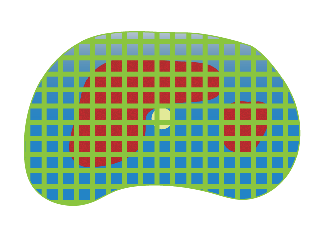 The red indicates location of tumor. The circle in the middle indicated the location of urethra.