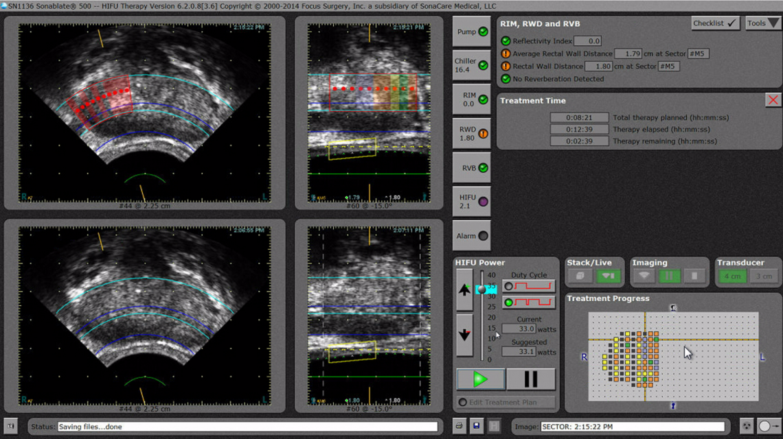 Tissue Change Monitoring - Sonablate HIFU