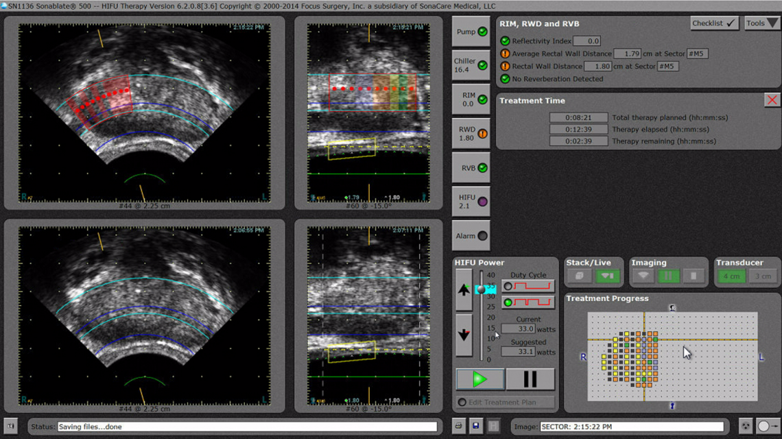 Tissue Change Monitoring - Sonablate HIFU 