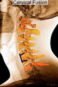 Cervical Fusion